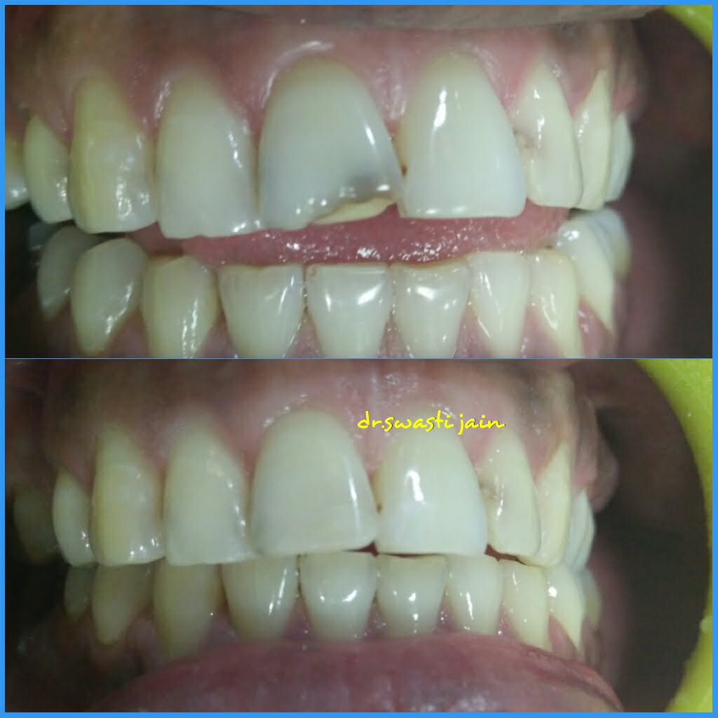 teeth filling Dentist in Vaishali
composite filling in vaishali ghaziabad
dental filling in vaishali
teeth color filling in vaishali 
teeth filling near me
laser teeth filling near me