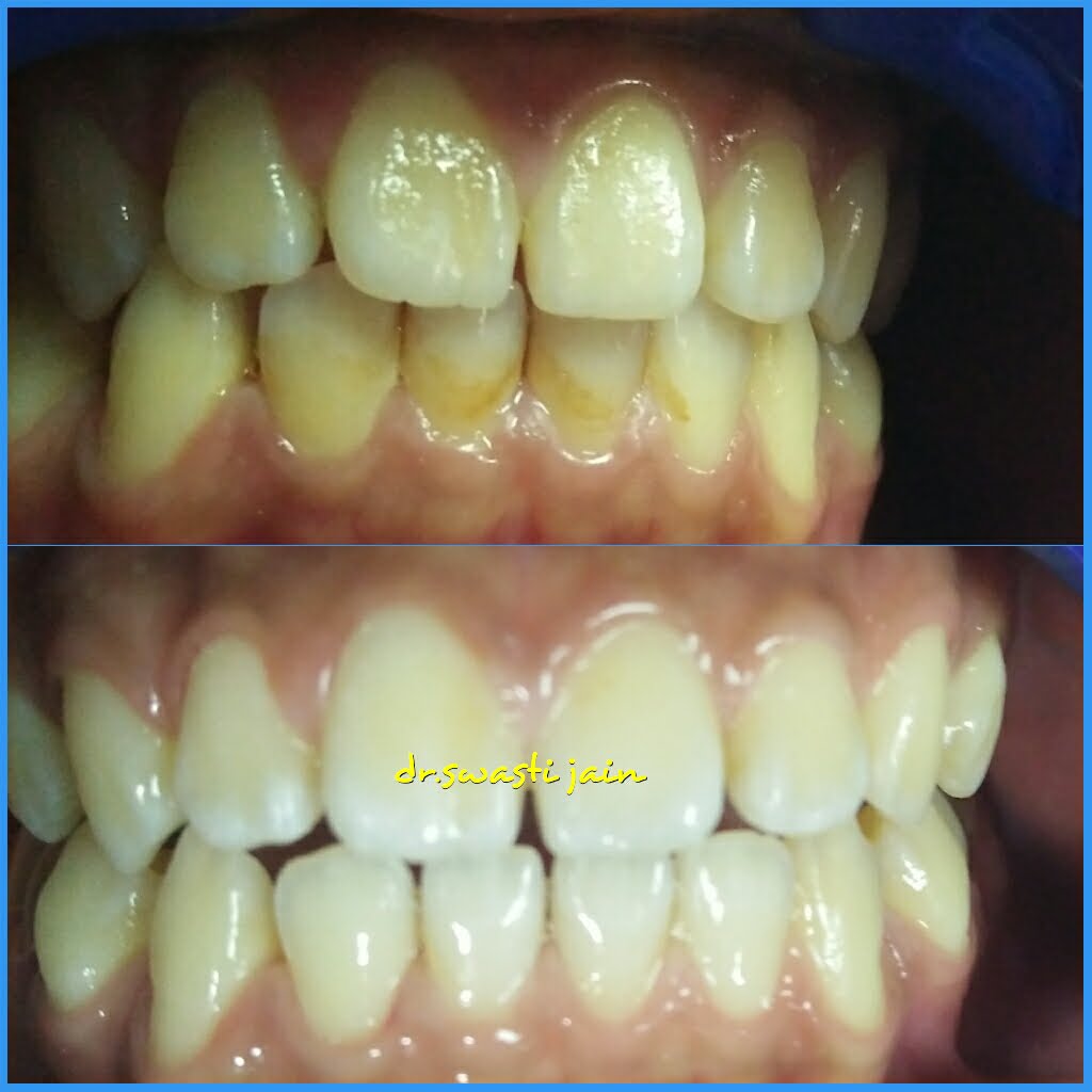 Scaling in Vaishali
teeth cleaning in vaishali ghaziabad
teeth polishing near me
ultra sonic scaling near me
best dentist for teeth scaling in vaishali ghaziabad
best dentist in kaushambi
best dentist in indrapuram
best dentist in vasundhara
dental clinic in indrapuram
rct in indrapuram