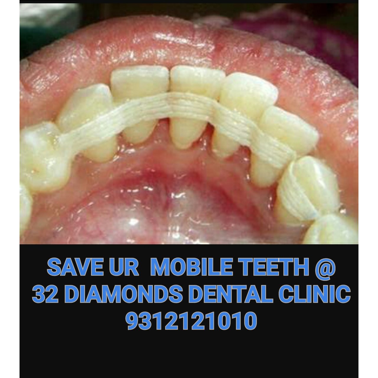 Treatment of Mobile Tooth / Splinting