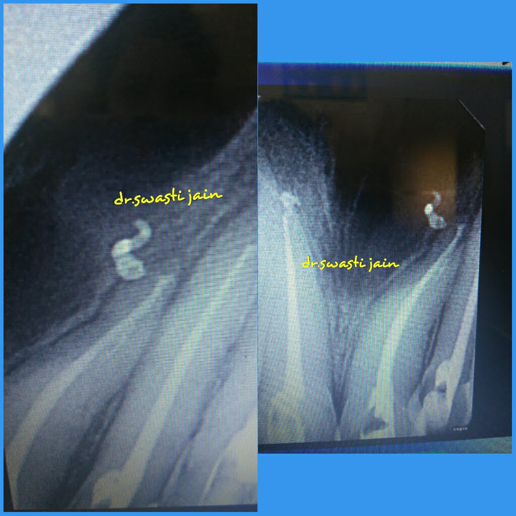 Re-Root Canal Treatment / RE RCT