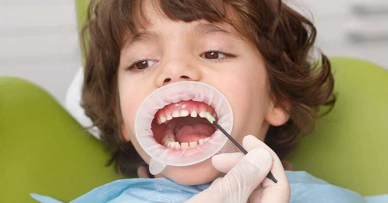 Fluoride Application Dentist in Vaishali
fluoride treatment for kids
fluoride treatment in vaishali ghaziabad