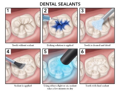 Tooth Sealants Dentist in Vaishali
tooth sealer in vaishali
how to choose best dentist in vaishali