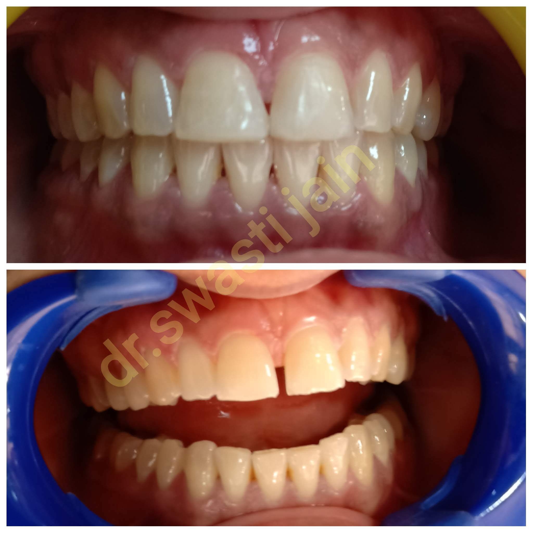 teeth gap reduction in vaishali
teeth gap treatment in vaishali ghaziabad
how to reduce teeth gap 
midline diastema treatment in vaishali ghaziabad
