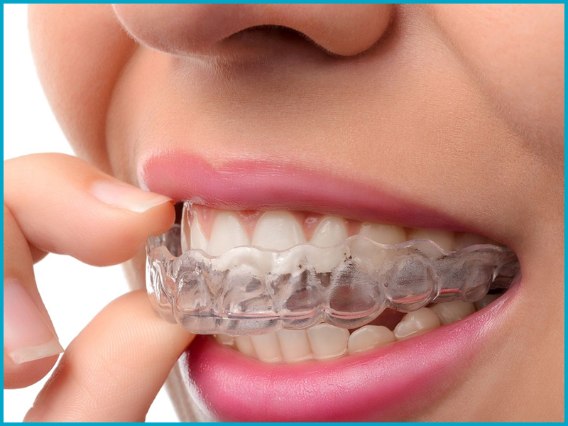aligners near me
invisible braces near me
best orthodontist near me
clear braces in vaishali ghaziabad
best dental clinic for invisalign in vaishali
invisalign treatment in vaishali 
genuine invisalign in vaishali ghaziabad