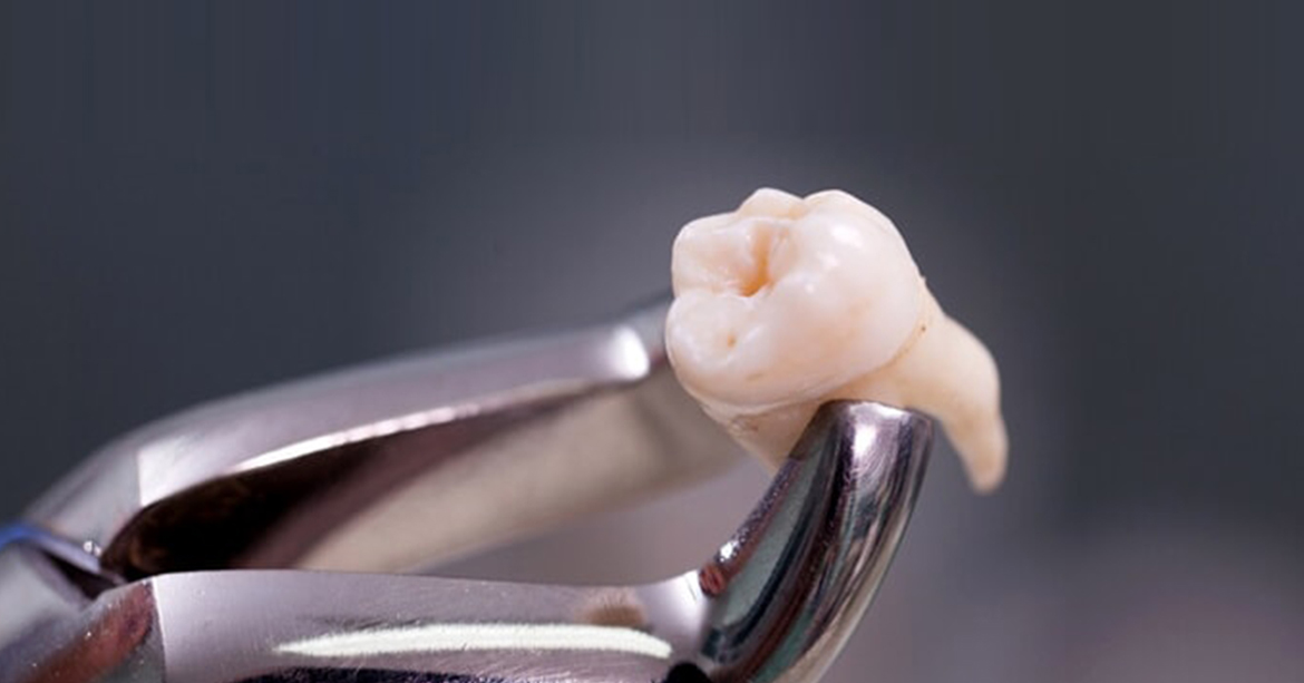 Wisdom Tooth Surgeries  in Vaishali
third molar surgery near me
cost of 3rd  molar removal
wisdom tooth removal
impaction surgery in vaishali ghazibad