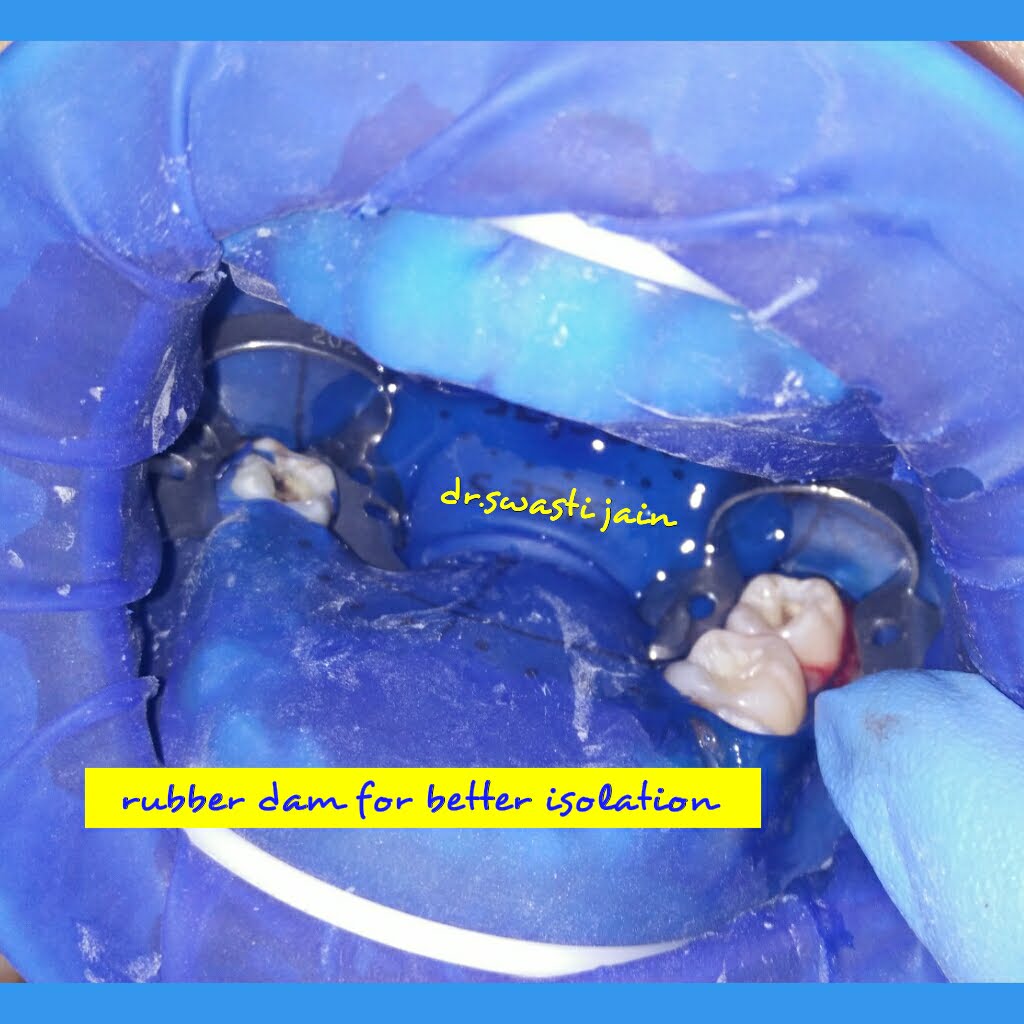 rubber dam in vaishali
use of rubber dam in dentistry
rct under rubber dam in vaishali ghaziabad
dentist using rubber dam in vaishali
best dentist in kaushambi
best dentist in indrapuram
best dentist in vasundhara
dental clinic in indrapuram
rct in indrapuram