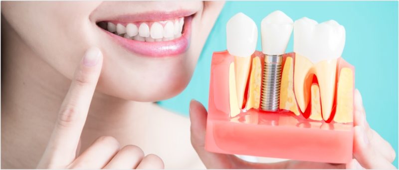 Dental Implants