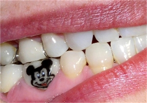 dental tattoo in vaishali
tattoo in vaishali