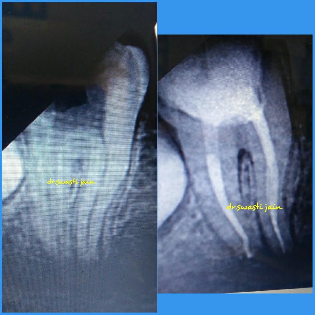 Dental X-Rays