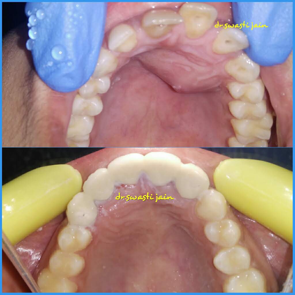 Gum Care Dentist in Vaishali
dentist for gum problems in vaishali
treatment of swollen gums near me
treatment of bleeding gums in vaishali ghaziabad
tartar removal in vaishali
receeding gums treatment in vaishali 