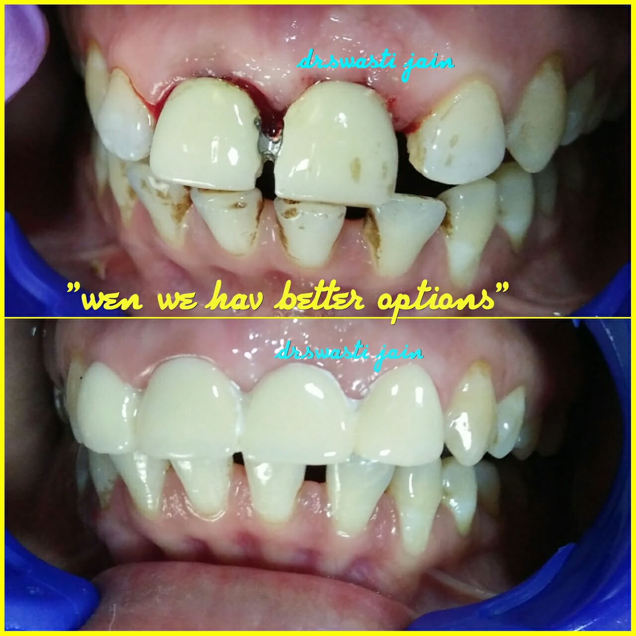 All Ceramic Crown V/S Metal + Ceramic Crowns