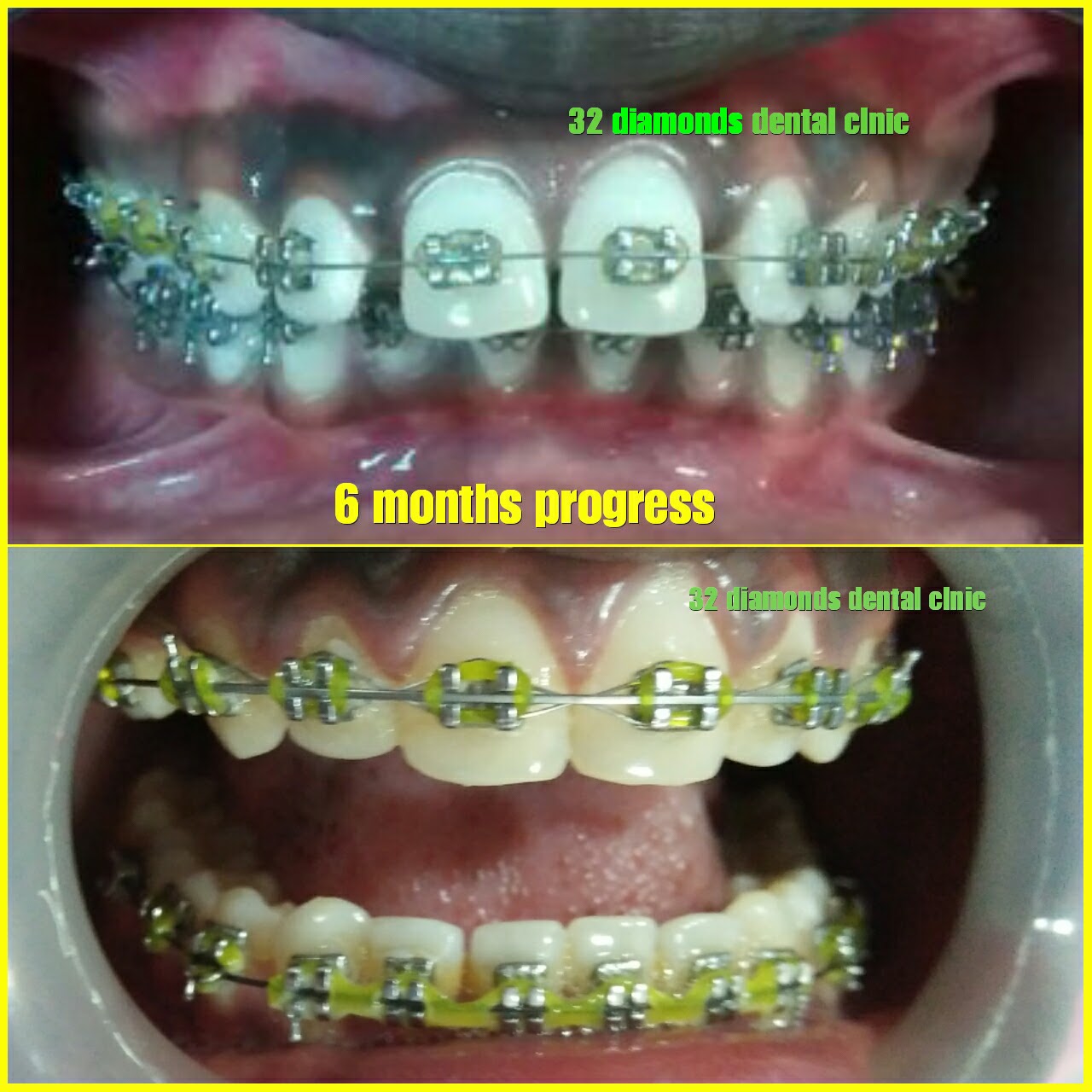 Lingual Braces