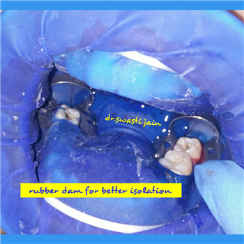 Rubber Dam in Dentistry